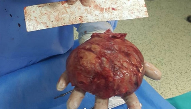 Hastanın şişen karnından 20 santimlik miyom çıktı