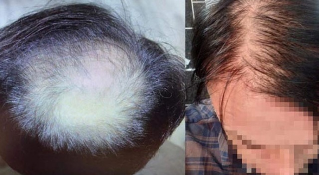 Saç ekiminden memnun kalmayan mühendis dava açtı