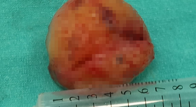 Kalbinden 6 cm kitle çıktı