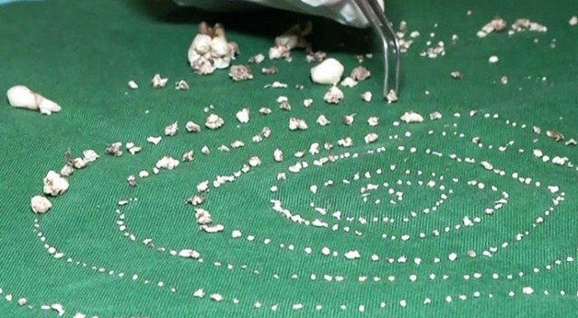 7 yaşındaki çocuğun ağzından 526 diş çıkarıldı 7 yaşındaki çocuğun ağzından 526 diş çıkarıldı