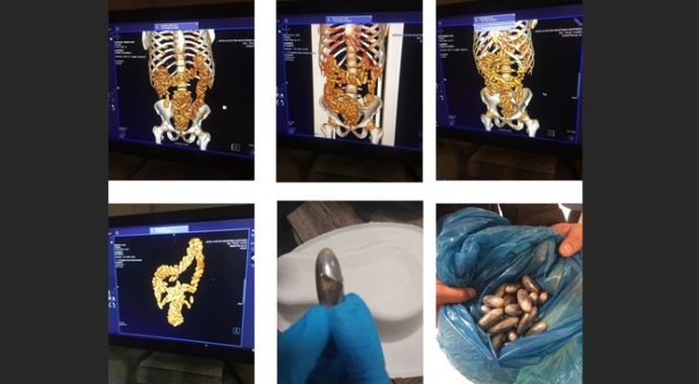 Şüphe üzerine çekilen tomografi gerçeği ortaya çıkardı! Tam 3 kilo 400 gram... Şüphe üzerine çekilen tomografi gerçeği ortaya çıkardı! Tam 3 kilo 400 gram...