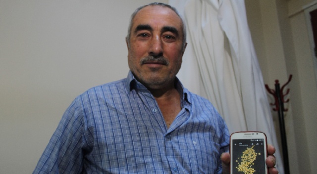 Mesanesinden 199 adet nohut büyüklüğünde taş çıktı