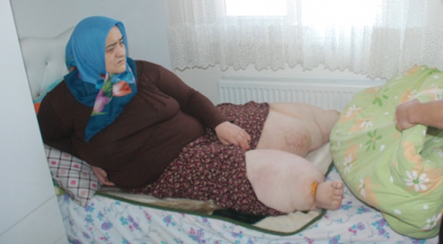 Trafik kazası sonrasında bacakları şişen kadın yaşam savaşı veriyor Trafik kazası sonrasında bacakları şişen kadın yaşam savaşı veriyor