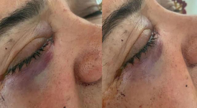 Pencereden bakmak isteyen kadının gözüne saçma isabet etti Pencereden bakmak isteyen kadının gözüne saçma isabet etti