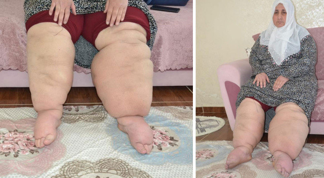 Hayatı kabusa döndü! Bacakları günden güne şişiyor, 15 yıldır hastalığına teşhis konulamıyor Hayatı kabusa döndü! Bacakları günden güne şişiyor, 15 yıldır hastalığına teşhis konulamıyor