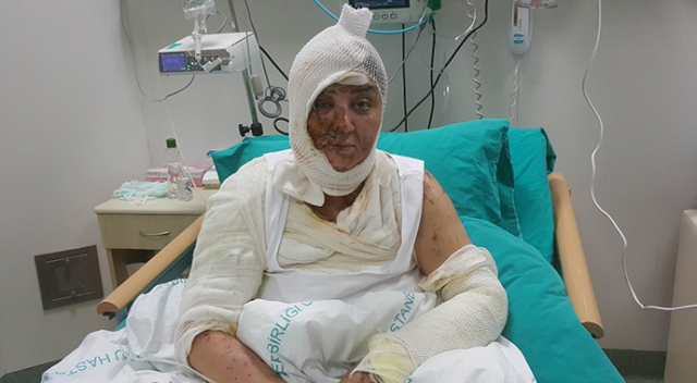 Tacize karşı koydu, kezzapla yakıldı