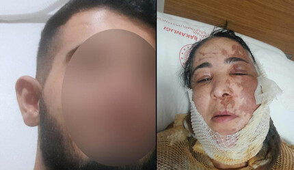 Adana'da üvey evlat dehşeti! Kimseyle evlenmesin diye üvey annesinin yüzüne kezzap döktü - gundem
