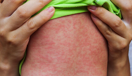 Kızamık vakaları endişelere neden oldu, uyarılar peş peşe geldi - saglik