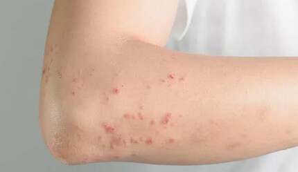 Dini törende bulaştı: ABD'de 20 bin kişiye kızamık salgını uyarısı - saglik