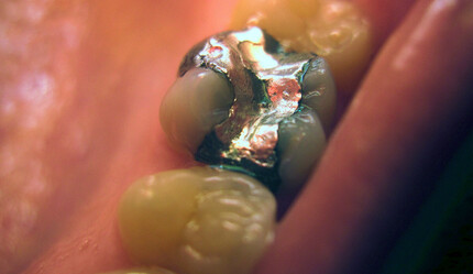 Uzmanı ‘risk taşıyabilir’ diyerek uyardı: Dişinde amalgam dolgu olanlar dikkat! - saglik