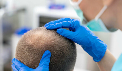 Saç ekiminde 'merdiven altı' tarih oluyor! Yeni standartlar getirildi - saglik