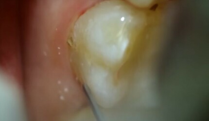 Çöp diye atıyorduk! Oysa diş tartarlarını silip süpürdüğü ortaya çıktı - saglik