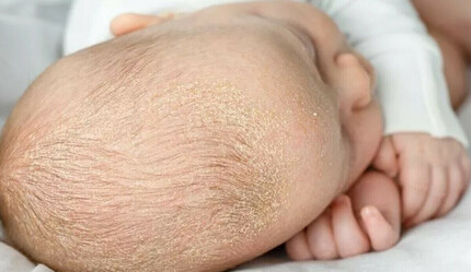 Bebeğinizdeki konak sizi telaşlandırmasın | Türkiye Kliniği - turkiye-cumartesi
