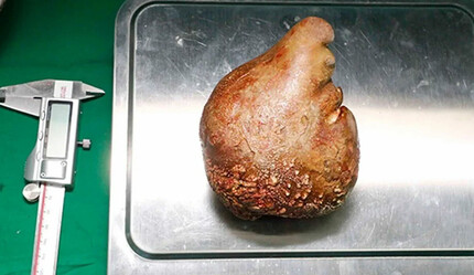 Dünya rekoru kırıldı: Hastadan 801 gram ağırlığında böbrek taşı çıkarıldı - gundem