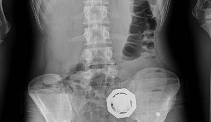 Bağırsaklarında uyuşturucu taşıyan 4 kişi tutuklandı - gundem