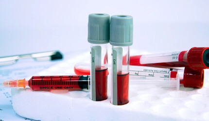 Kan tahlili ile alzaymıra teşhis - saglik