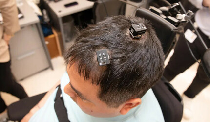 Yapay zeka beyin çipi takılan hastanın hisleri geri geldi - teknoloji