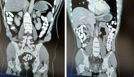 Okuyunca şaşkına döneceksiniz: Midelerinden 2 kilo uyuşturucu çıktı - gundem