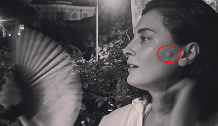 Oyuncu Aslıhan Gürbüz fotoğraflarını paylaştı, herkes yanağındaki şişkinliğe takıldı - magazin