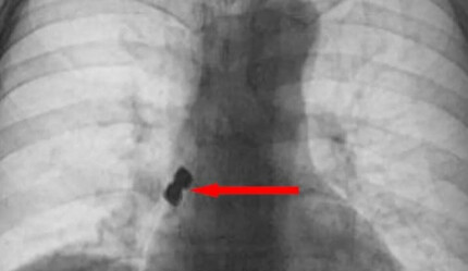 Diş doktorunda implantı yuttu, az kalsın canından oluyordu - gundem