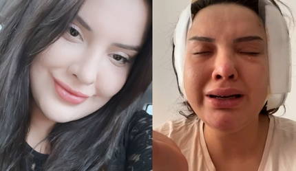 Estetik ameliyat faciaya dönüştü! 'Badem göz' tanınmaz hale getirdi - yasam
