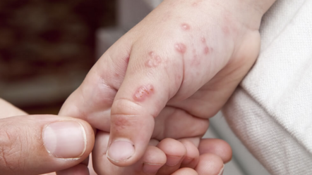 ZONA nedir, bulaşıcı mı, belirtileri neler? Zona hastalığının tedavi yöntemleri… - haberler