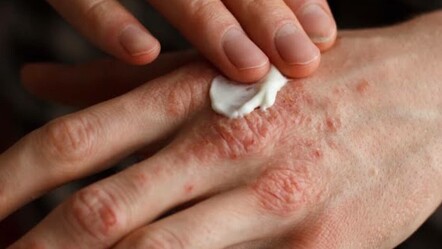 Cildinizde çıkan lekeler sandığınız kadar masum olmayabilir! Sedef hastalığı ve belirtileri nedir, nasıl tedavi edilir? - saglik