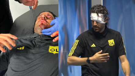 Marsilyalı holiganlar Olimpik Lyon'u taşladı, Fabio Grosso'yu bu hale getirdi - spor