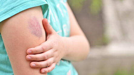 Çocuğunuzun vücudundaki morlukları dikkate alın - saglik