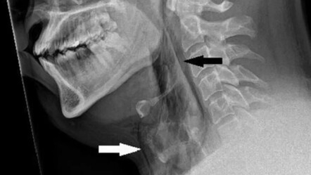 Hapşırığını tutan adamın boğazında delik açıldı - saglik