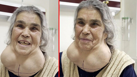 50 yıldır hastane kapısından geçmiyordu! Yüzü tanınmaz hale gelince doktora gitti… Meğer tek sebebi varmış - saglik