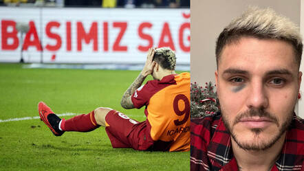Derbide Icardi'nin elmacık kemiği kırıldı! 'Boks ringlerinde olacak şekilde yumruk atıldı' - spor