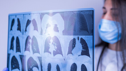 Uzmanı grip sonrası asıl tehlikeyi açıkladı: Bağışıklığı düşen kişilerde sık görülüyor - saglik