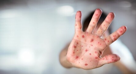 Türkiye'de kızamık salgını var mı? - dunya