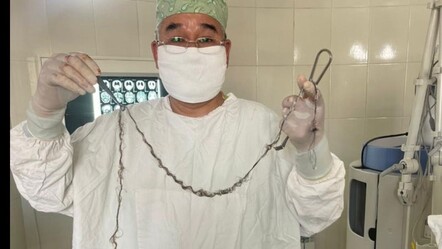 Beyninde kitle keşfedilmişti: Saçı yıllarca içeri doğru uzamış! - saglik