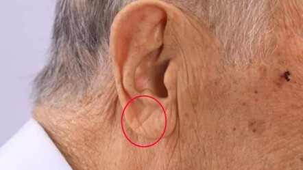 Hemen kontrol edin! Kulağınızdaki çizgi sinsi hastalığın habercisi - saglik