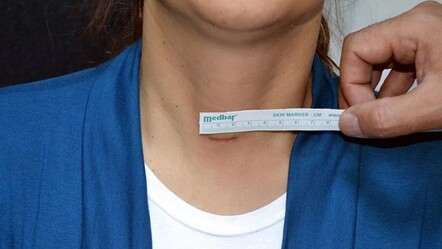 Kuaförlerin fark ettiği hastalık! Tiroit kanseri görülme sıklığı arttı - saglik