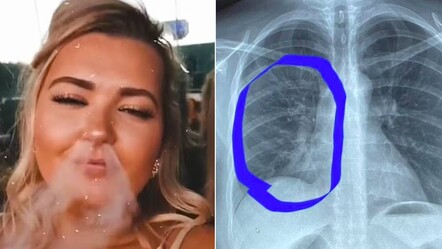 Elektronik sigara kullanan kadının ciğerlerinden patlama sesi geldi - gundem