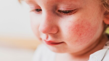 Çocuğun yanağında tokat izine benzer bir kızarıklık varsa dikkat! Vakalar arttı, uzmanlar uyardı - saglik