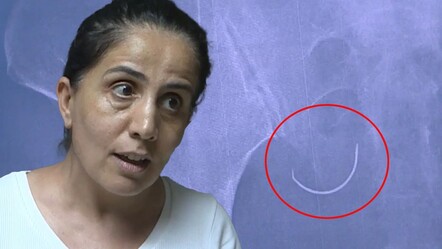 1,5 yıl ağrıyla yaşadı! Tüp bebek tedavisinde karnında iğne unutulduğu fark edildi - saglik