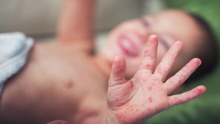 Anne babalar dikkat: Salgın var! El, ayak, ağız hastalığı en çok havuzdan bulaşıyor - saglik