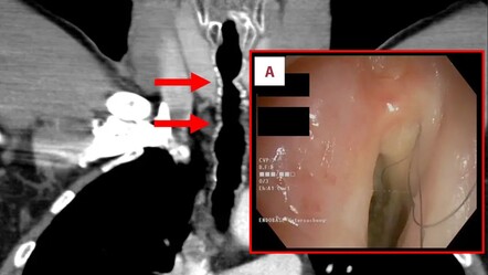Doktorları şaşırtan vaka: Sigara içen adamın boğazında kıllar çıktı - gundem