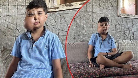 Milyonda bir görülen hastalık: İki farklı yüzü var gibi görünüyor, ailesi doktor doktor gezip çare arıyor - saglik