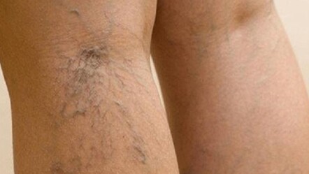 En büyük düşmanı kuma yatmak! Kendi küçük ama derdi büyük hastalığı tetikliyor - saglik