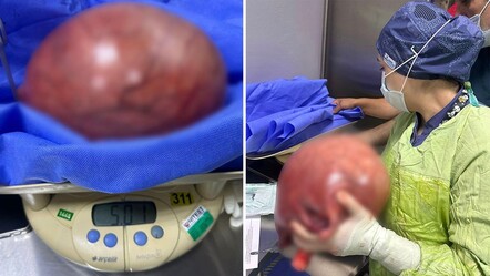 Karın ağrısı şikayetiyle hastaneye gitti, rahminden 5 kilogramlık kitle çıktı - saglik