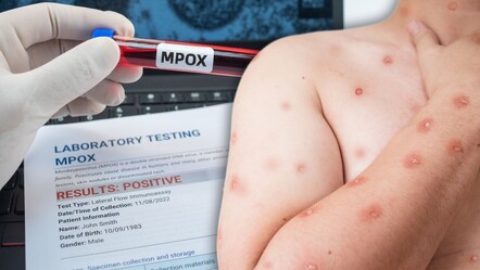 'Maymun Çiçeği' hastalığı hortladı! Afrika alarmda, Türkiye'de son durum ne? - gundem