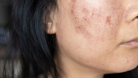 Deri hastalıkları yazın kabusu oldu! Uzmanı uyardı: Kanser riski var, önleminizi alın - saglik