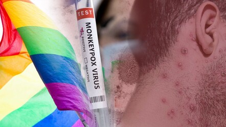 Maymun çiçeği virüsü cinsel yolla bulaşmaya ne zaman başladı? Neden önce eşcinseller aşılandı? - saglik