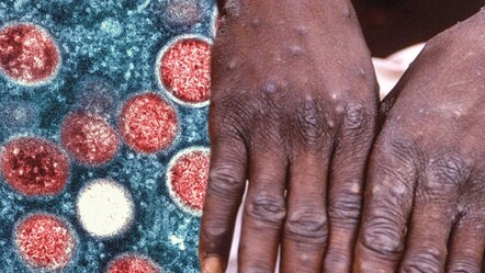 Duymayan kalmasın: Bu belirtiler maymun çiçeği habercisi! Halsizlik, ateş, baş ağrısı yaşıyorsanız… - saglik