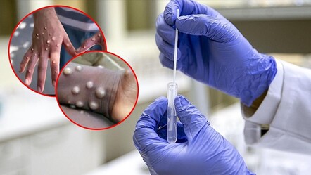 Maymun çiçeği virüsü dünyaya yayılıyor! İsveç'in ardından bir ülkede daha görüldü - gundem